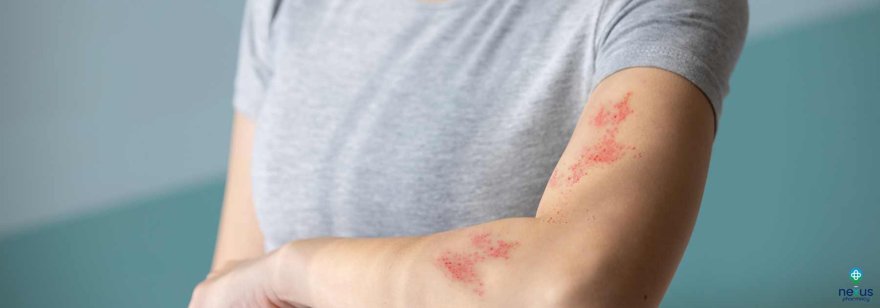 shingles treatment in Nottingham